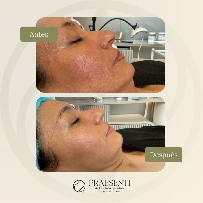 Antes y después Limpieza facial con Hydrash - PRASENTI