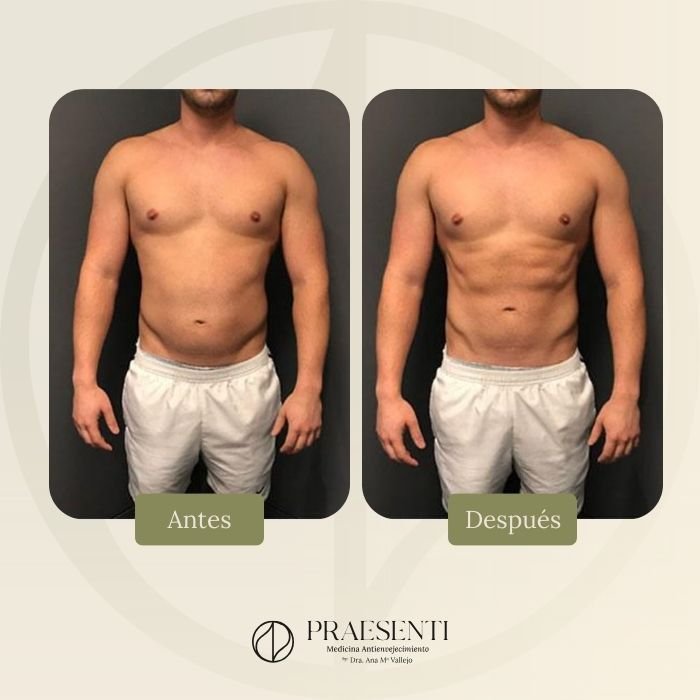 Antes y después musculptech - PRASENTI