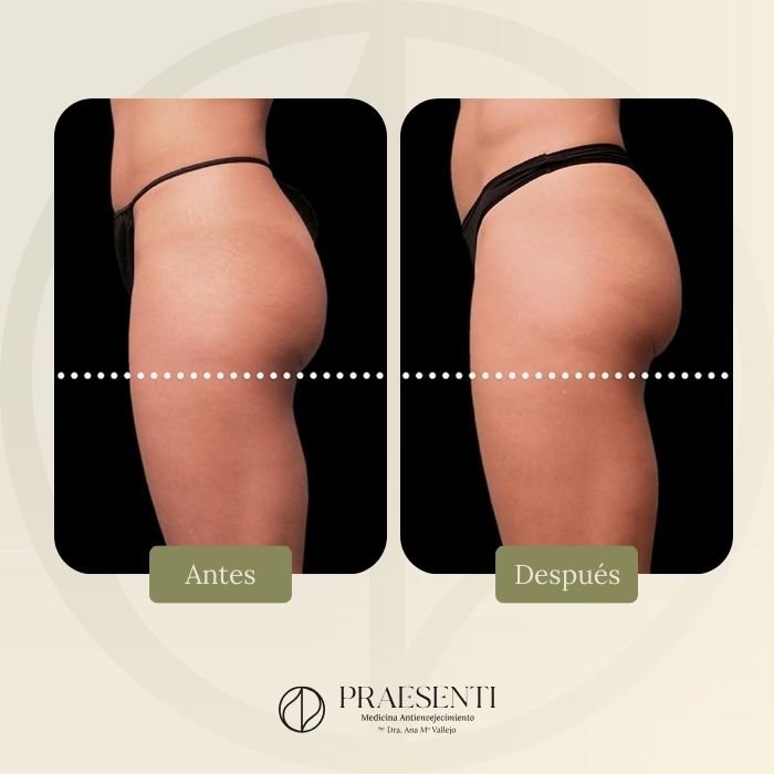 Antes y después musculptech - PRASENTI