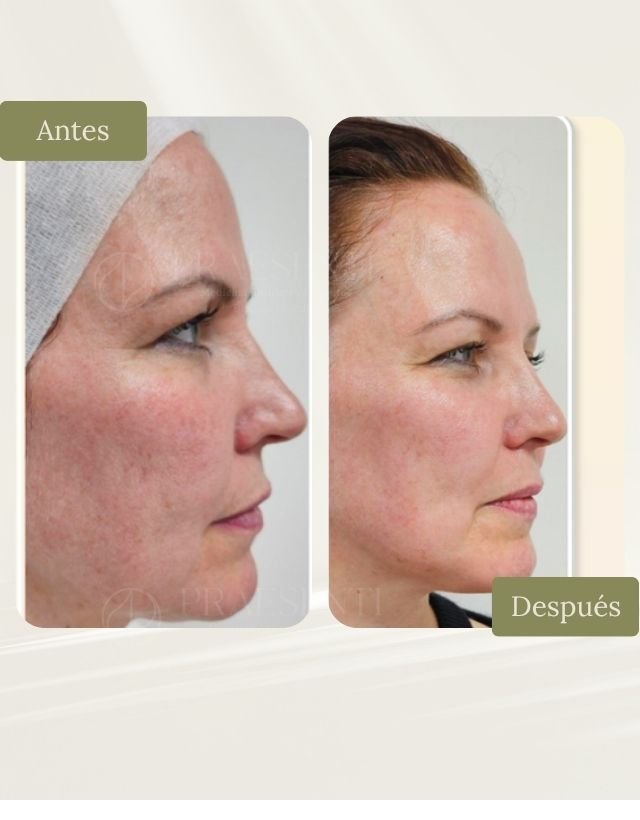 Liftera antes y después - Praesenti Clinic - Bogotá - Imagen de referencia 4