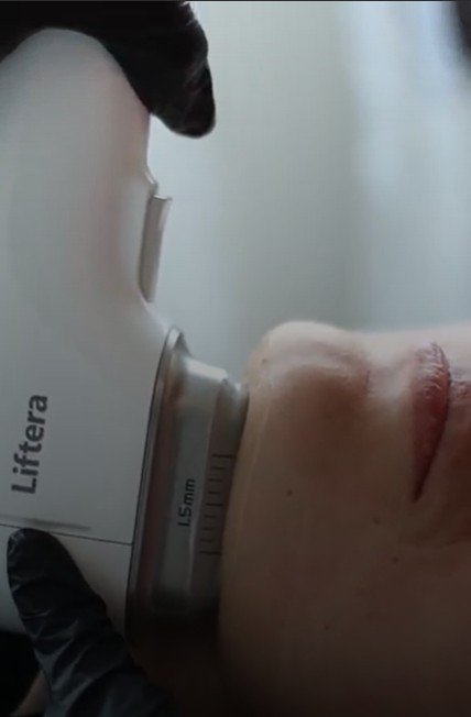 Cómo eliminar la papada con liftera-Praesenti
