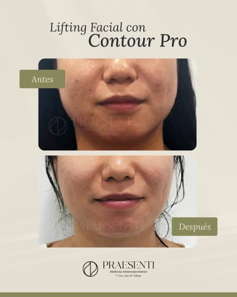 Contourpro antes y después - Praesenti Clinic
