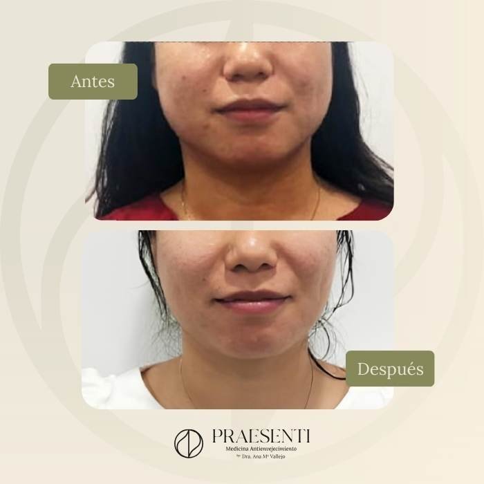 Contourpro antes y después - Praesenti clinic - Clínica estética en Bogotá