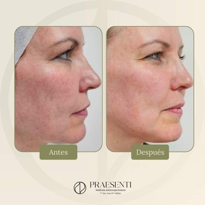 Liftera antes y después - Praesenti clinic - Clínica estética en Bogotá