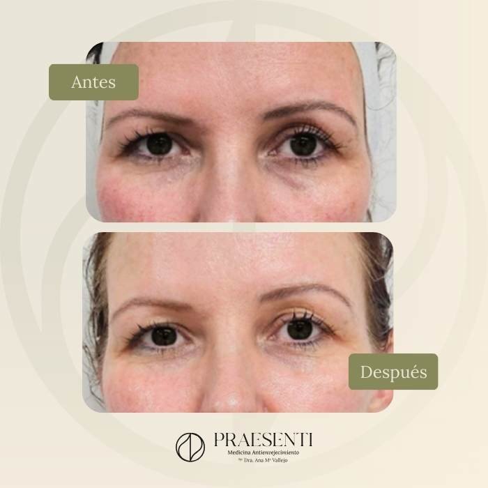 Liftera antes y después clínica estética en Bogotá Praesenti