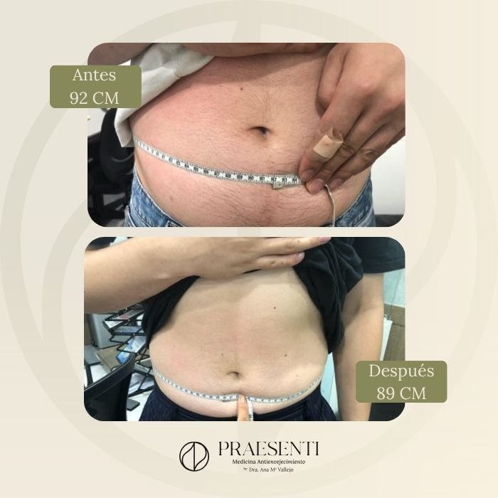 Contourpro antes y después - Praesenti clinic - Referencia 2