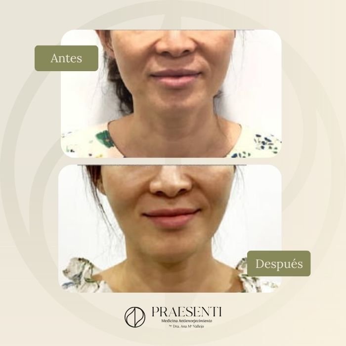 Contourpro antes y después - Praesenti clinic - Referencia