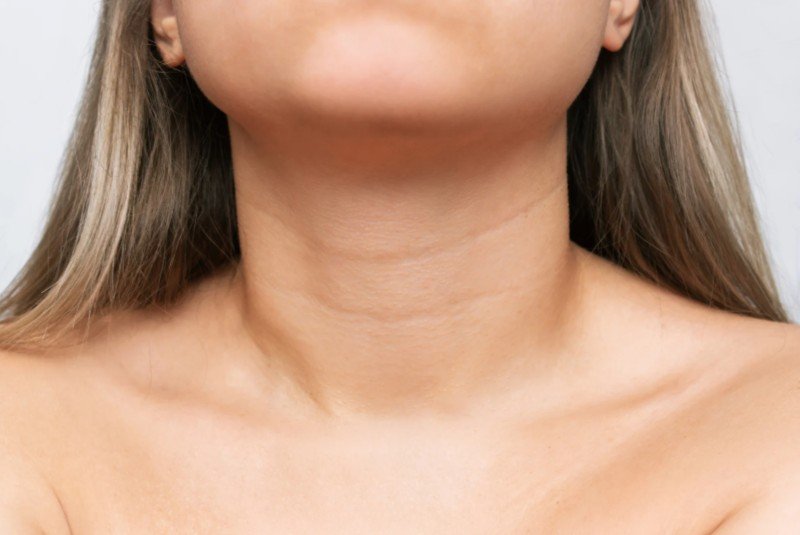 Sculptra cuello y escote - Praesenti clinic Bogotá