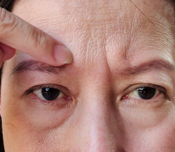 Botox en el entrecejo - clínica estética praesenti de Bogotá