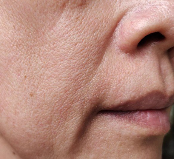 Botox en surcos nasogenianos - clínica estética praesenti de Bogotá