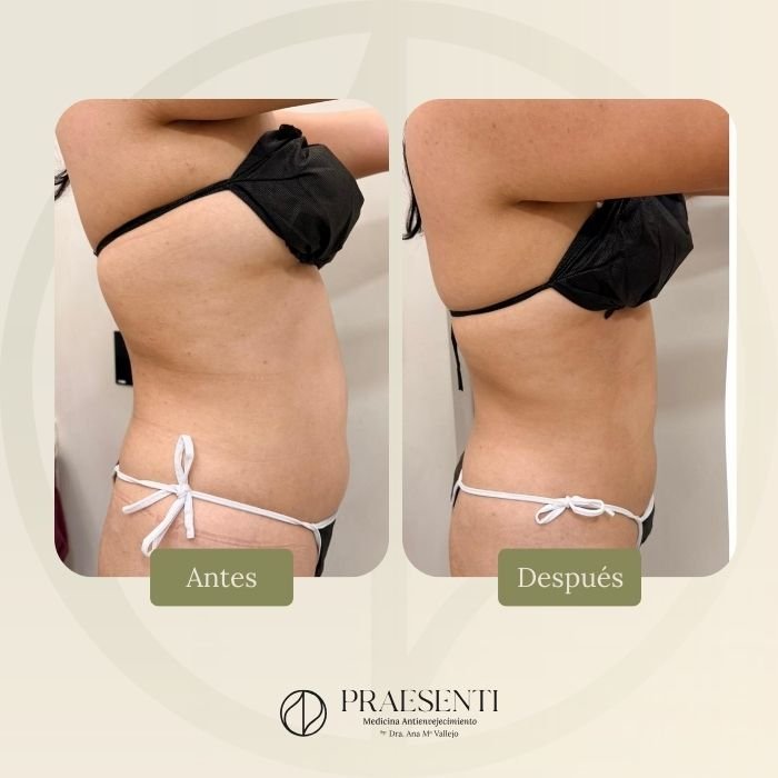 Reducción de medidas con Contour Pro - Caso de antes y después - Praesenti Clínica antienvejecimiento en Bogotá