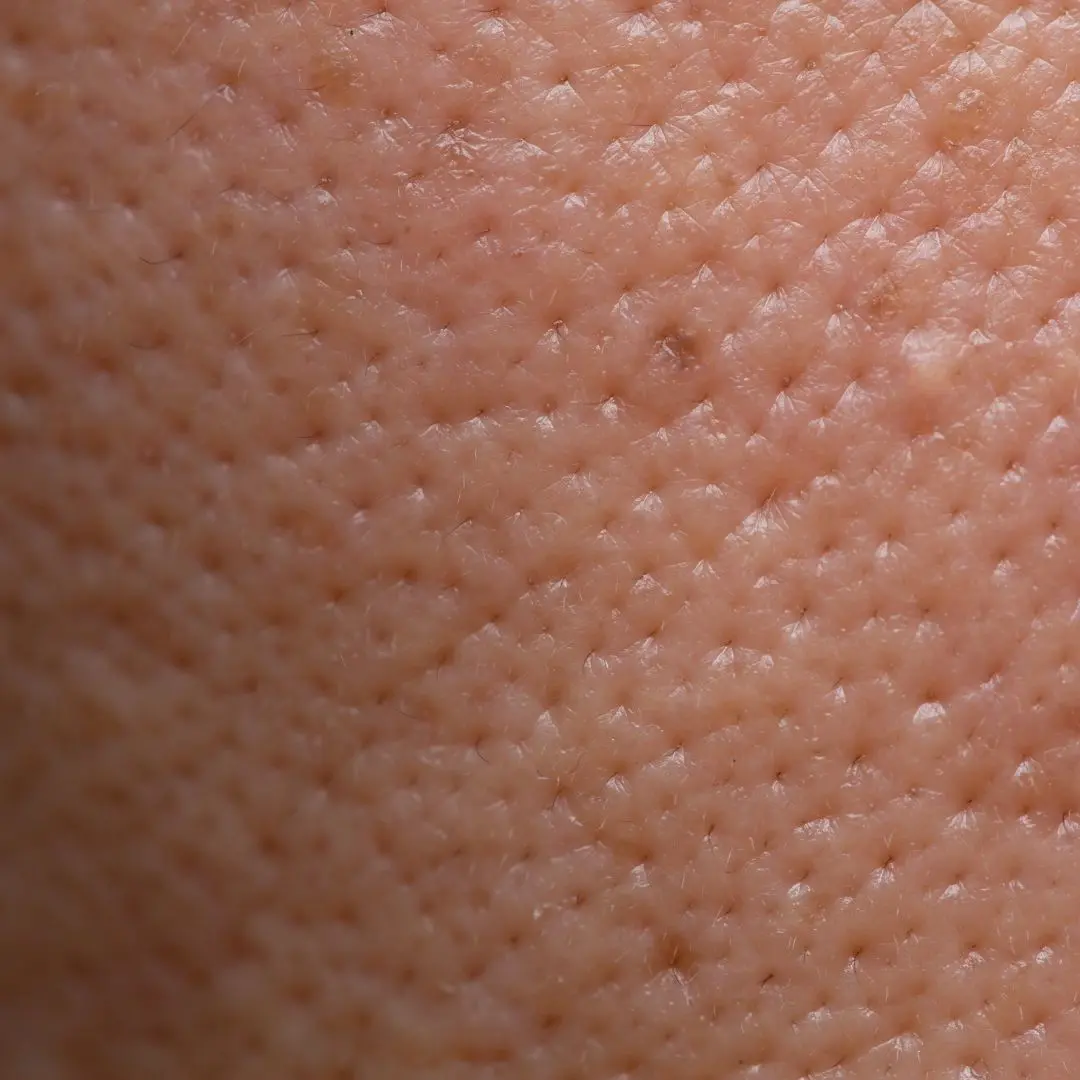 Poros abiertos en la piel - tratamiento en Praesenti clinic, en Bogotá