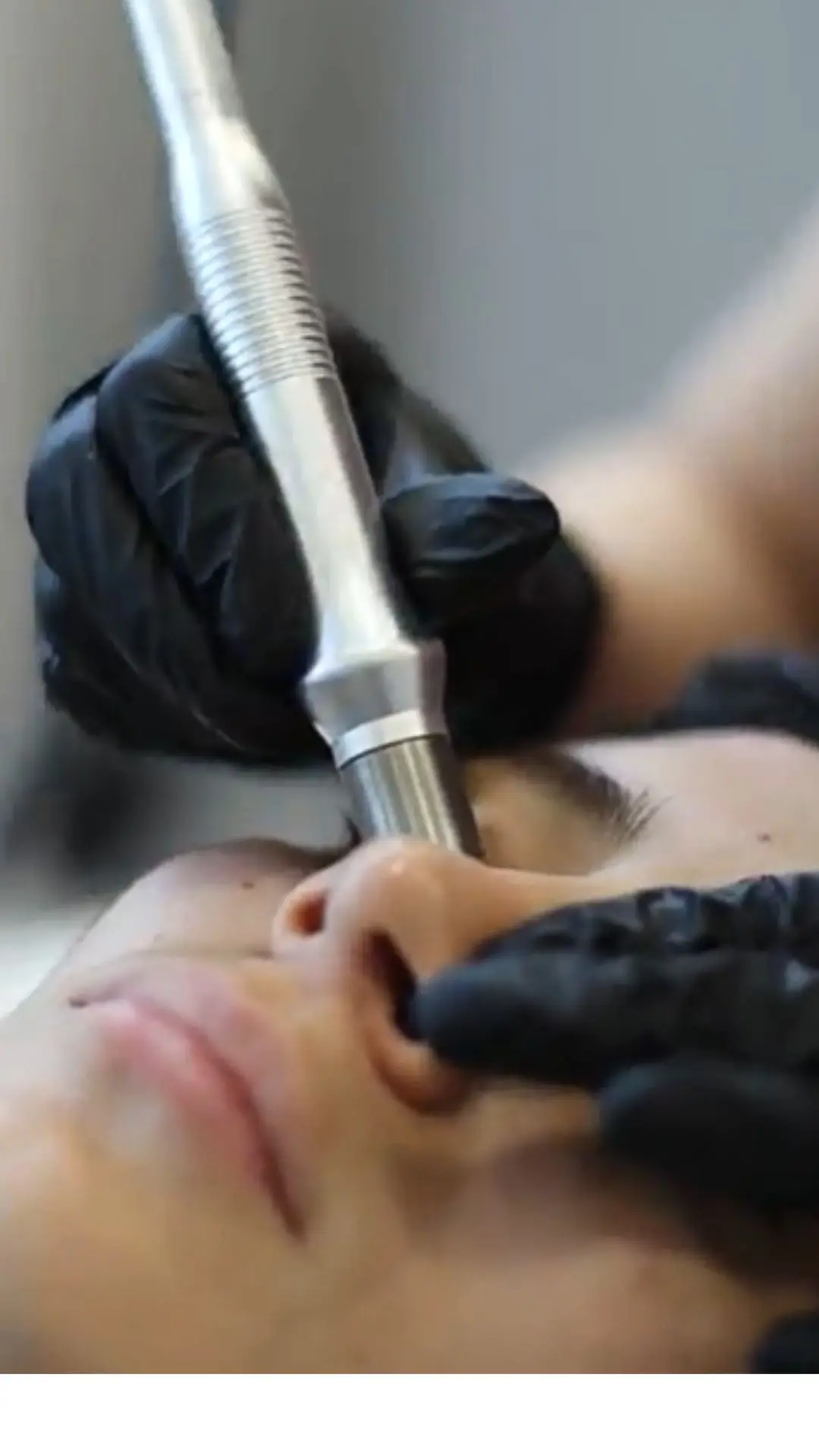 Tratamiento para los poros abiertos con Hydrash facial en Bogotá - Praesenti Clinic