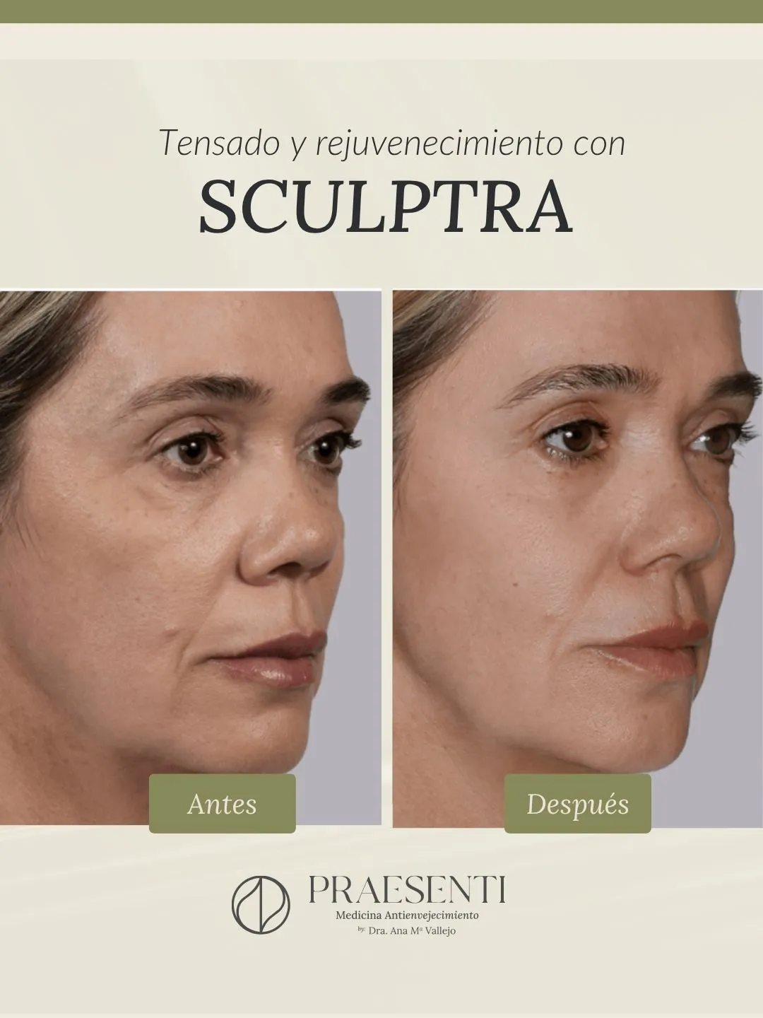 RESULTADOS SCULPTRA BOGOTÁ