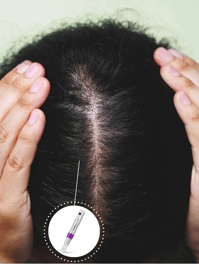 Tratamiento para la caida del cabello con mesoterapia capilar con nanopore en Bogotá - Clínica estética praesenti