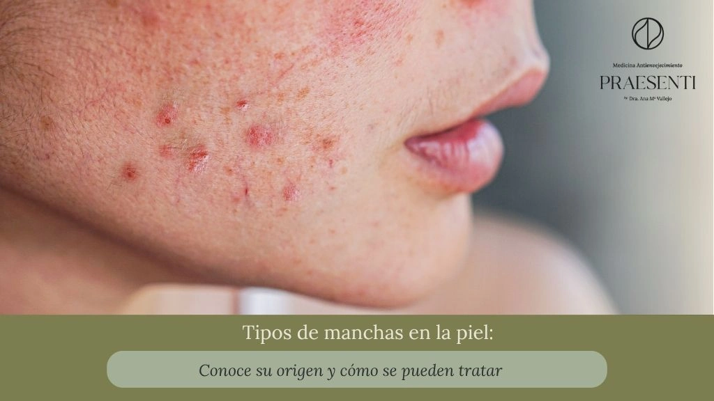 Tipos de manchas en la piel Conoce su origen y cómo se pueden tratar - Praesenti