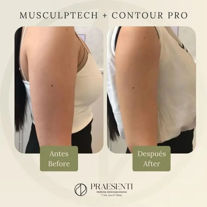 Tonificación de brazos musculptech y contour pro antes y después - Clínica estética de Bogotá Praesenti clinic 030926