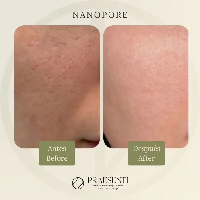 Tratamiento para cerrar poros con nanopore antes y después - Clínica estética de Bogotá Praesenti clinic 030926